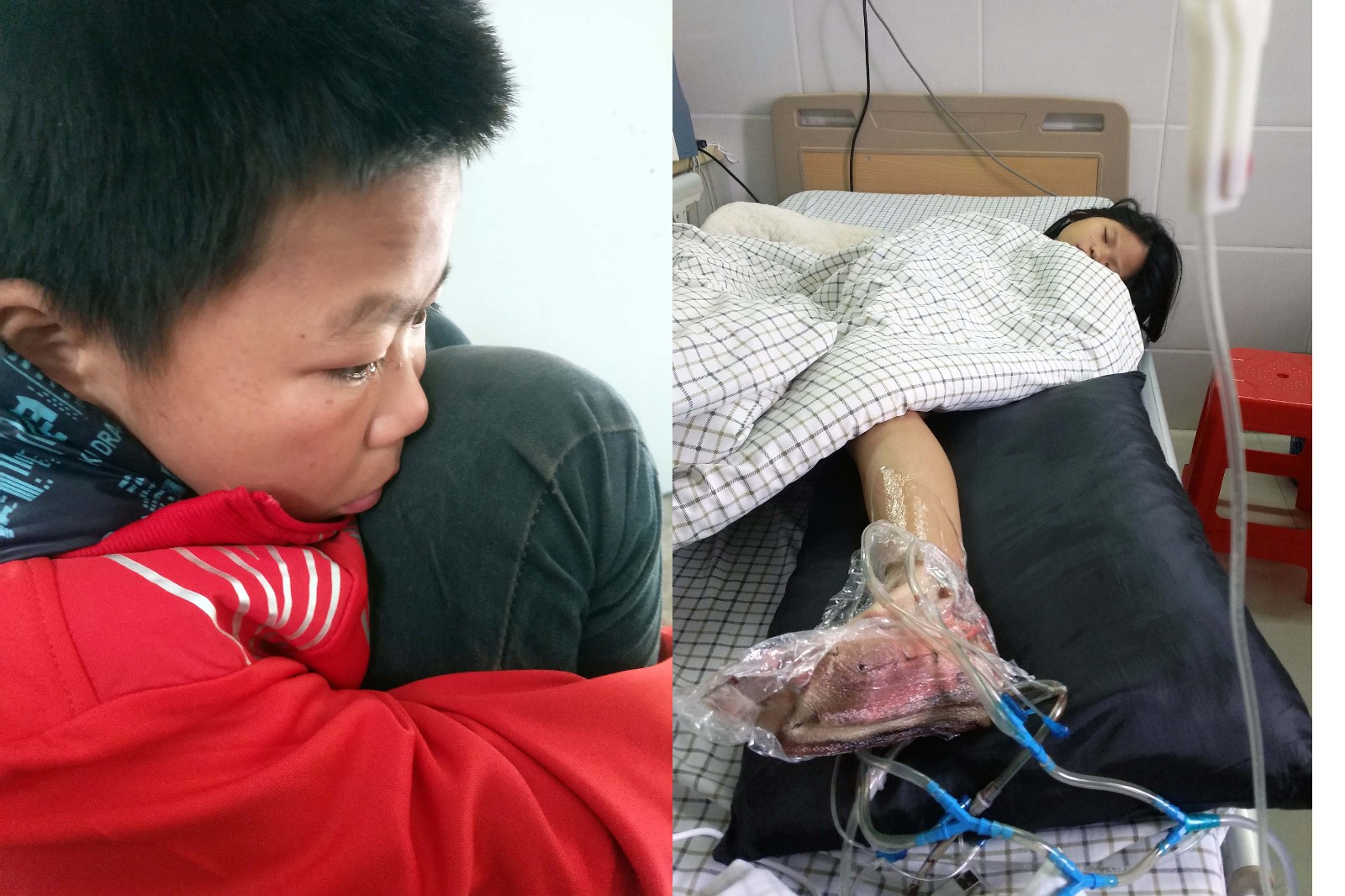 无麻 气道梗阻）且别无选择时